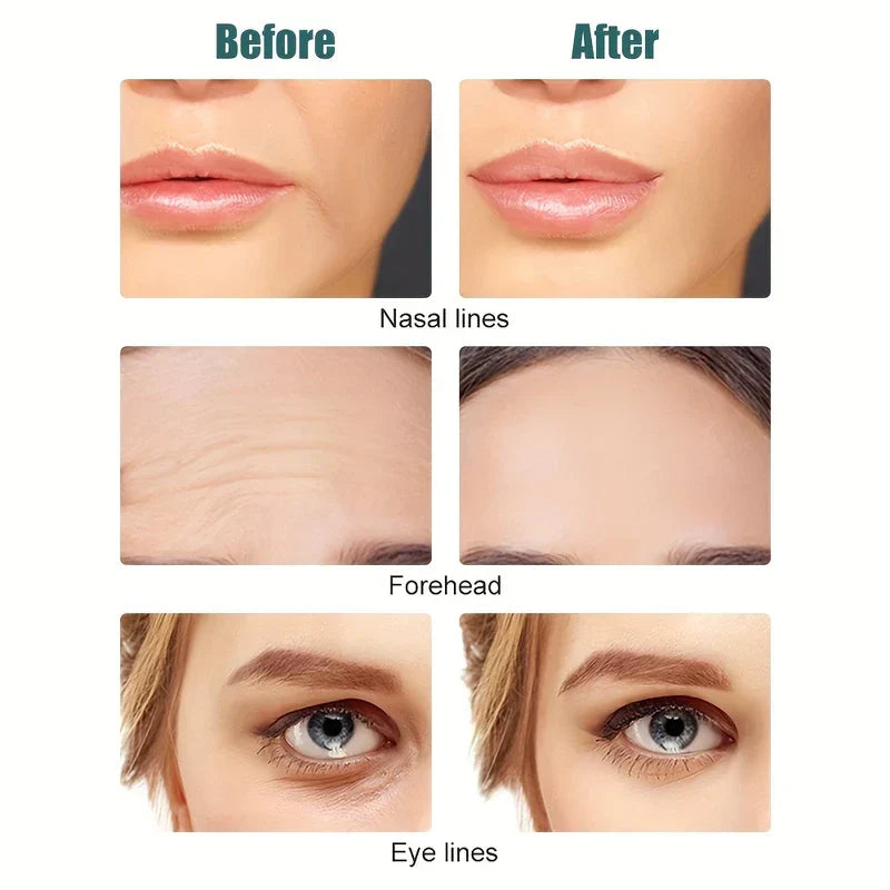 Before and after facial comparison showing reduction of nasal lines, forehead lines and eye lines.