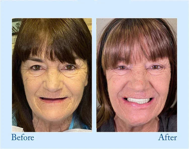 Before and after comparison of a smiling older woman showing results from a complete denture set
