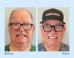Complete Denture Set - Side-by-side before and after portraits of a mustached man wearing glasses showing his changed teeth.