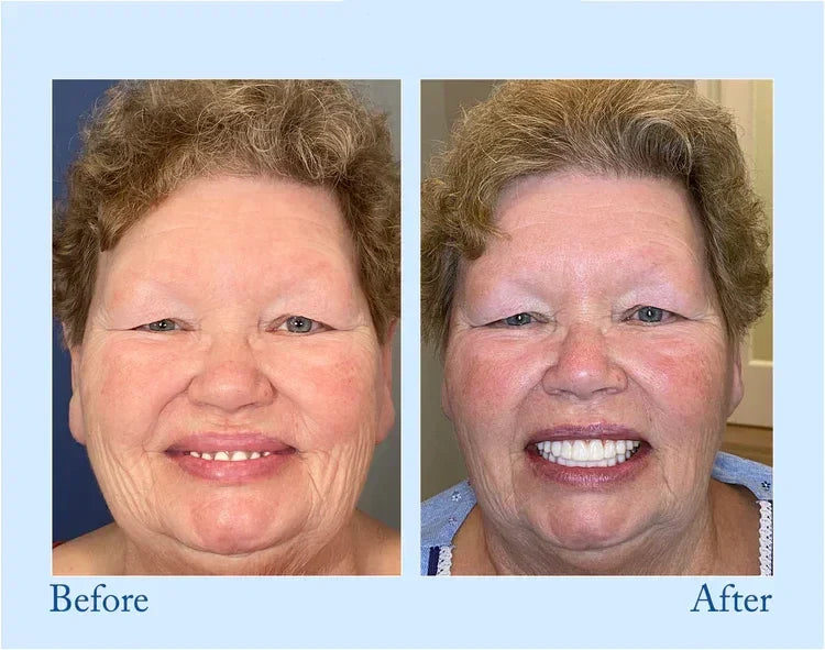 Complete Denture Set - Side-by-side before and after portraits of a woman with short curly hair showing her changed smile and teeth.