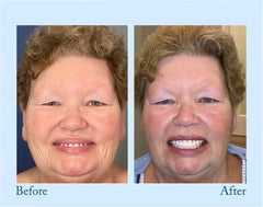 Complete Denture Set - Side-by-side before and after portraits of a woman with short curly hair showing her changed smile and teeth.