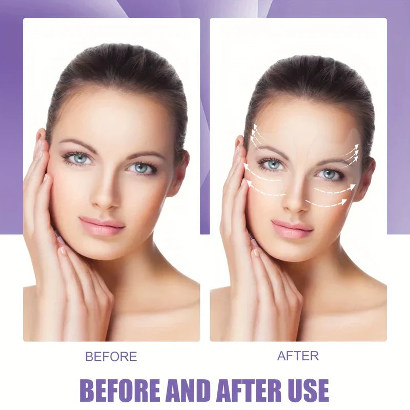 Frown Line Patches - Side-by-side before and after comparison of a woman's face, with lifting direction arrows shown on the after image