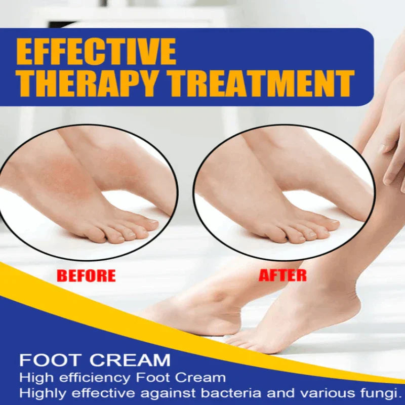 Antifungal cream for athlete's foot being applied to foot