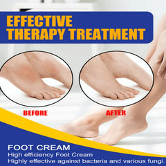 Athlete'S Foot Antifungal Treatment Cream Ointment