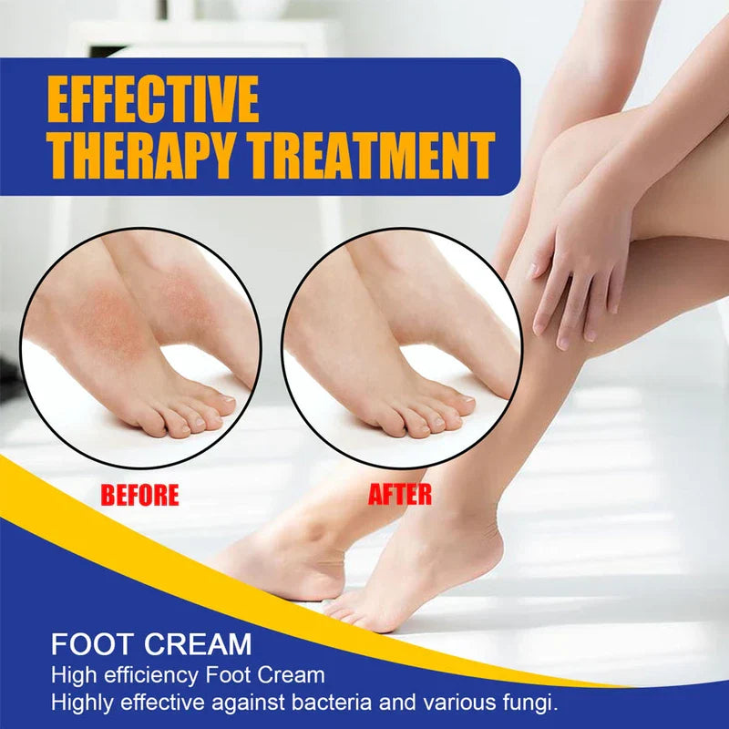 Athlete'S Foot Antifungal Treatment Cream Ointment