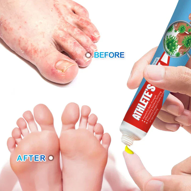 Athlete's Foot Ointment - Athlete's foot before-after comparison: foot with red scaly rash and discolored nail, then clear feet, plus hands squeezing yellow cream from a tube