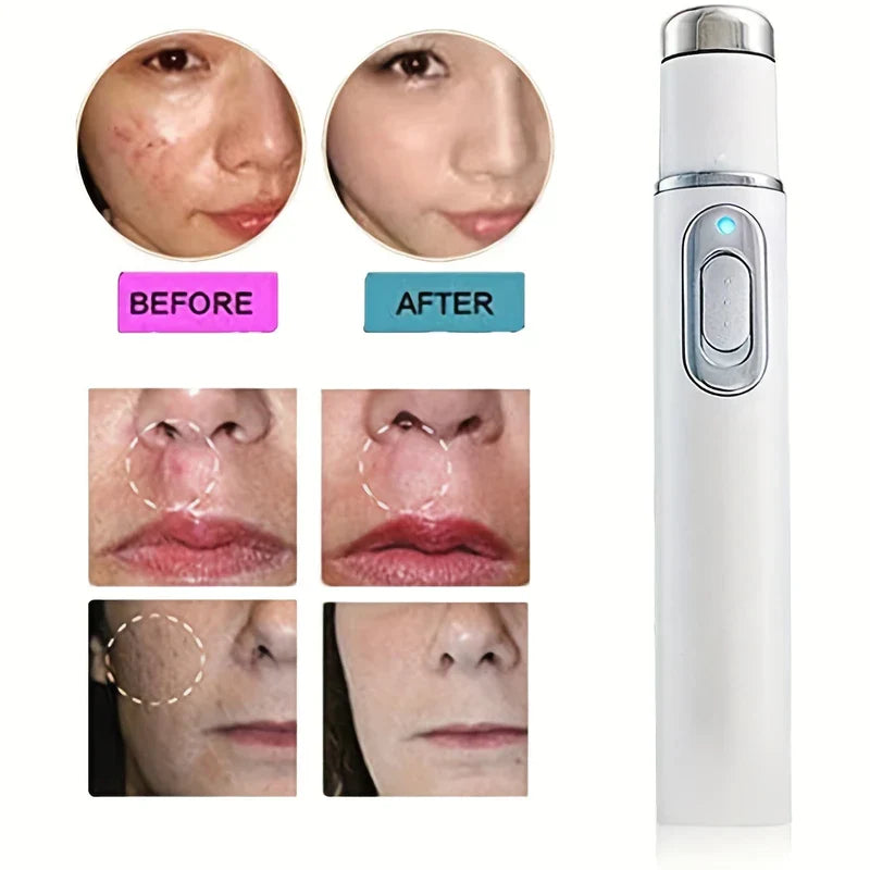 Blue Light Therapy Acne Treatment Pen