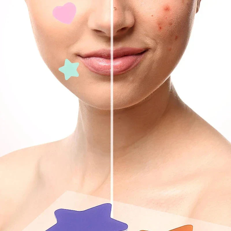 Colorful Hydrocolloid Acne Patches - Split view of a person's lower face: left side has pink heart and mint green star stickers, right side has blemished skin.