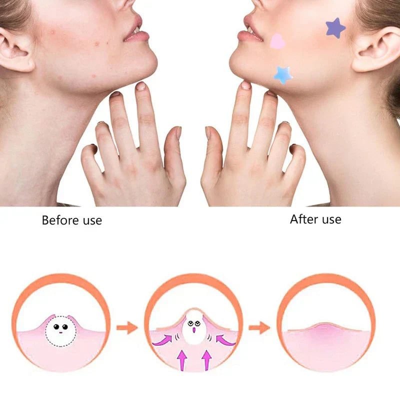 Colorful Hydrocolloid Acne Patches - Before/after side-by-side of a person with blemished skin, plus a 3-step skin diagram showing a blemish forming then flattening.