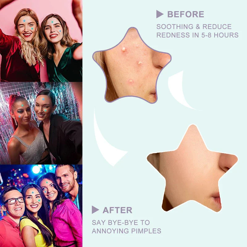 Colorful Hydrocolloid Acne Patches - Graphic showing before and after skin closeups with star-shaped pimple patches, plus three photos of people wearing the star patches