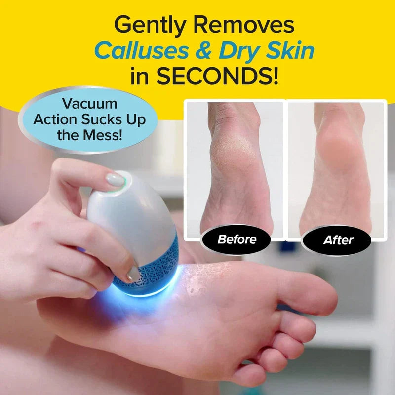 Electric Callus Remover with Built-in Vacuum