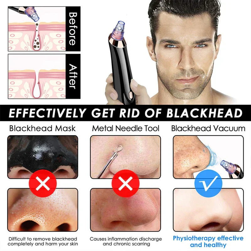 Vacuum Device - Before/after pore cross-section diagram, comparison of blackhead removal methods, tool held by male user