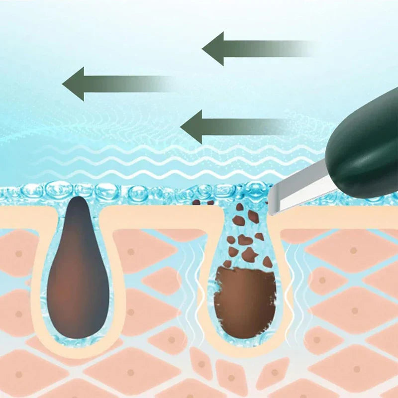 Skin Scrubber Spatula - Diagram showing the tool scraping dark debris out of a skin pore, with directional arrows above
