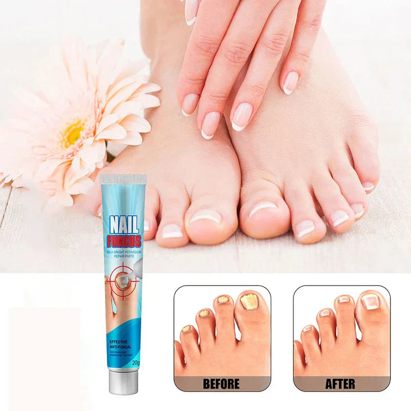 Anti fungal cream for nails with healthy hands and feet, plus before/after toenail comparison.