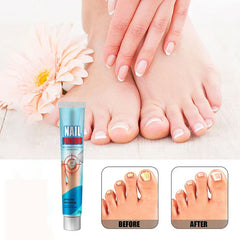 Anti fungal cream for nails with healthy hands and feet, plus before/after toenail comparison.