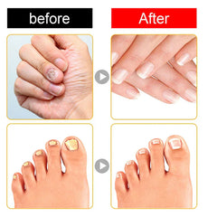 Before and after comparison grid of fingernails and toenails, showing discolored nails then healthy clear nails.
