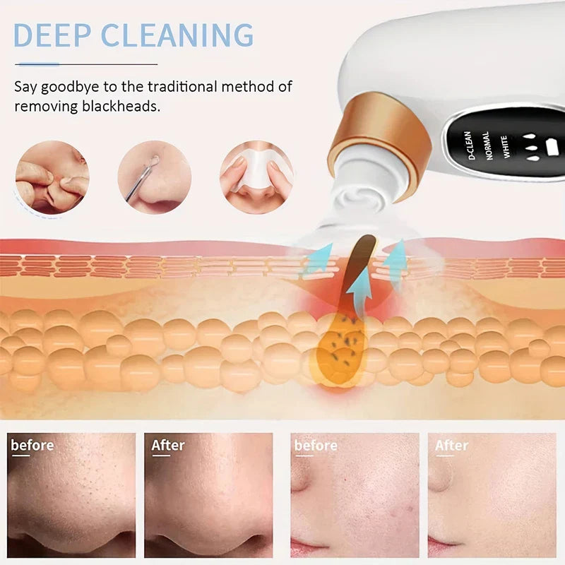 Rechargeable Blackhead Remover Vacuum Pore Cleaner