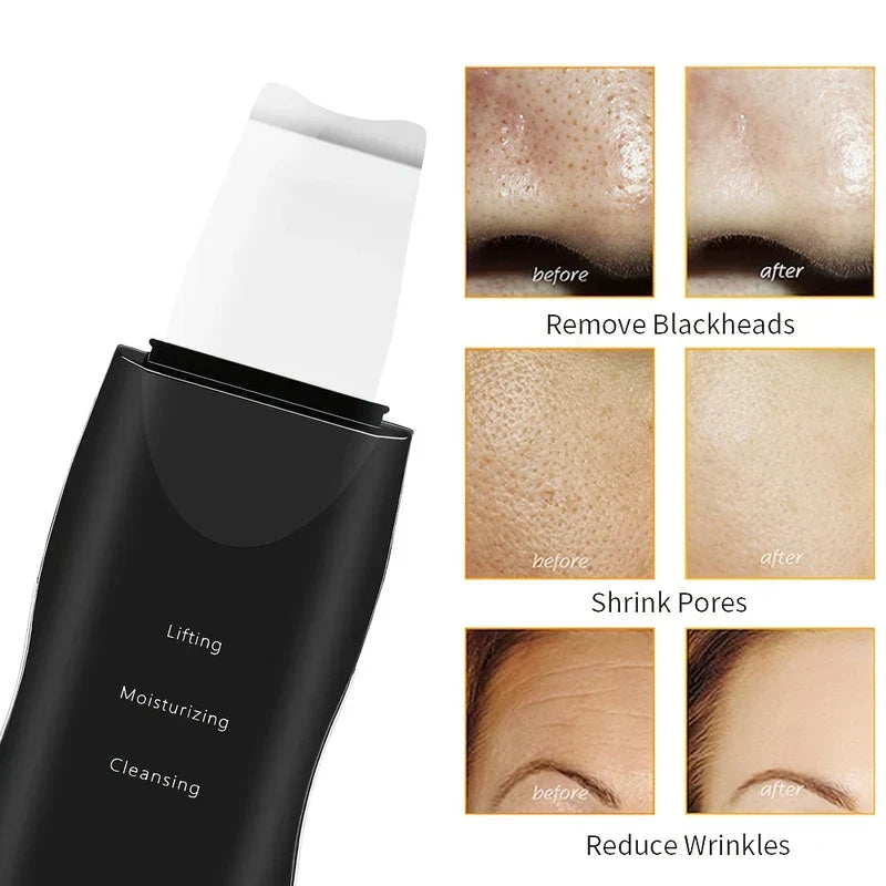 Espátula exfoliadora de piel: espátula exfoliadora ultrasónica negra junto a tres conjuntos de fotos comparativas de antes y después de la piel