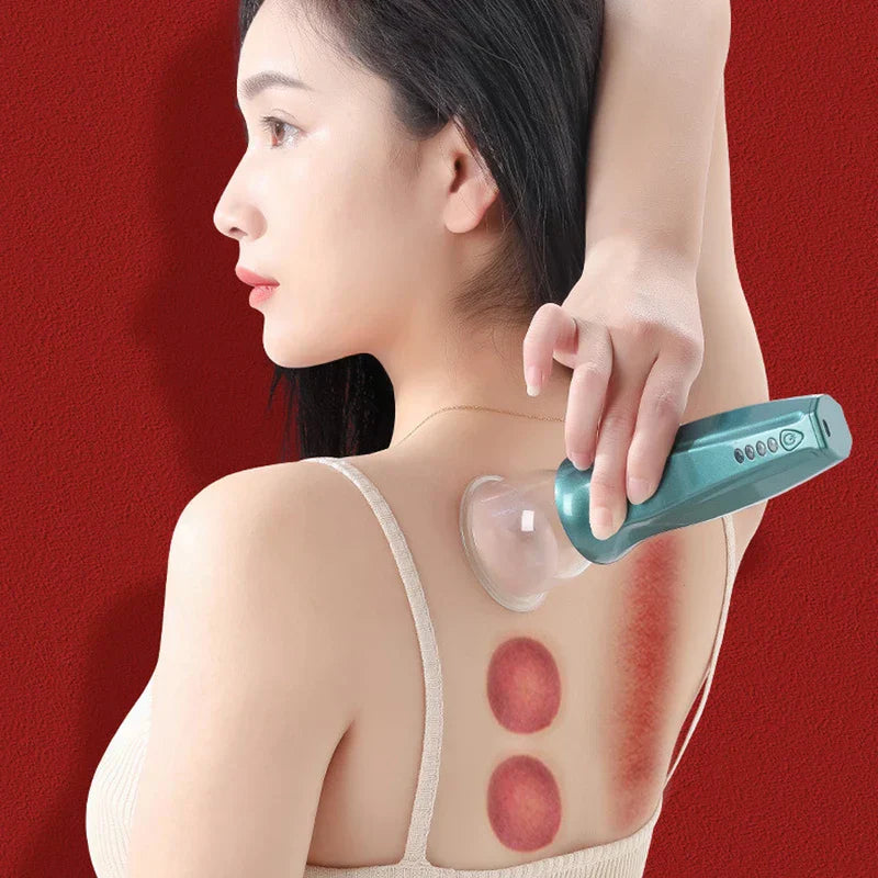 Person holding a teal cupping therapy set device with a clear cup pressed to the upper back, with visible red cupping marks on the skin