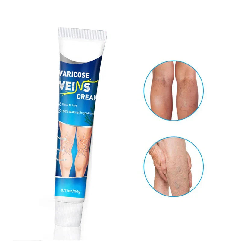 Varicose Vein Treatment Relief Cream