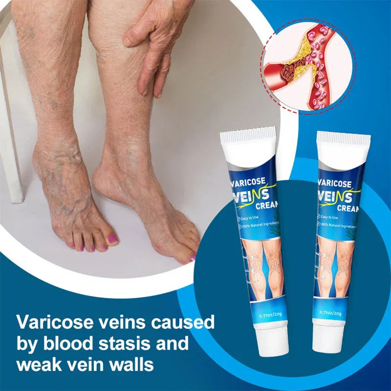 Itch Relief Cream - Image showing varicose veins on older person’s lower legs and feet, two varicose veins cream tubes, vascular blockage inset, text about varicose vein causes.