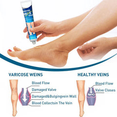 Itch Relief Cream - A hand squeezes varicose vein cream onto a person's foot; below, two diagrams compare varicose veins and healthy veins.