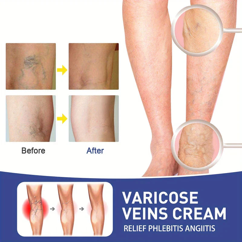 Varicose Veins Treatment Relief Patches