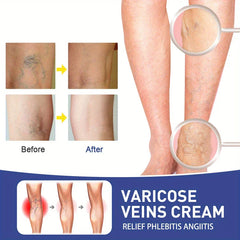 Varicose Veins Treatment Relief Patches