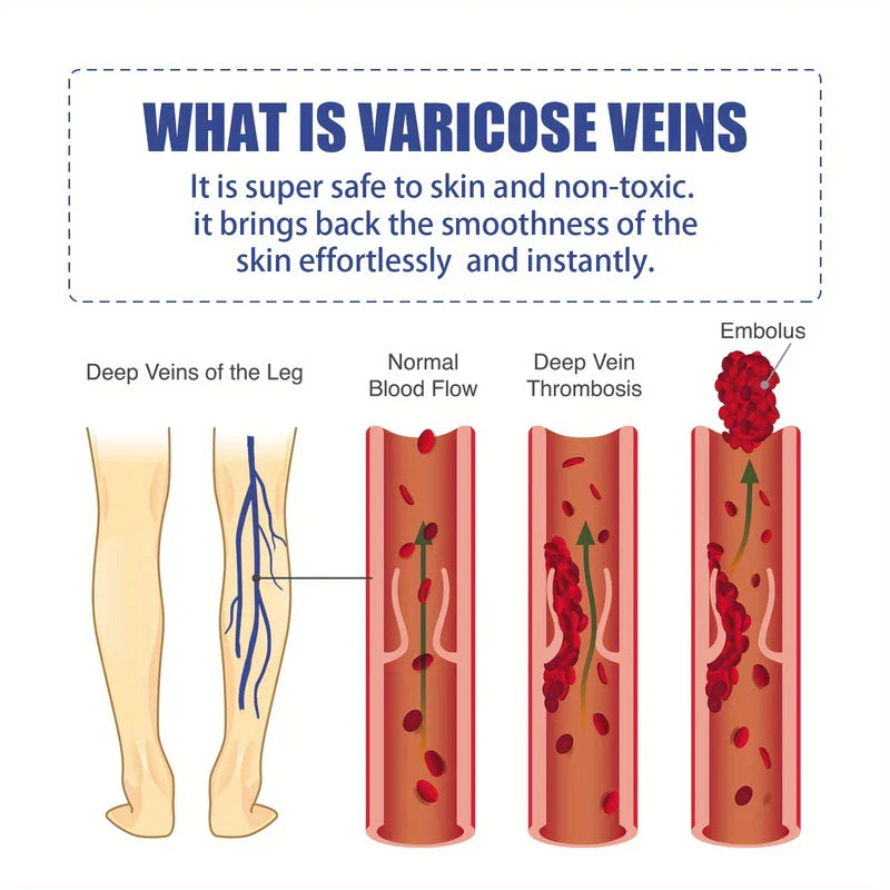 Illustrated diagram of leg veins and blood flow states with explanatory text