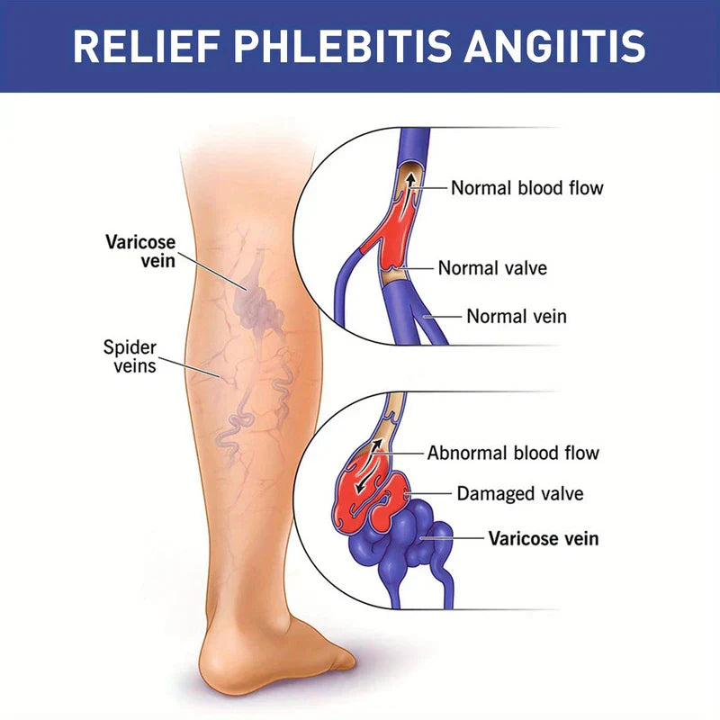 Medical illustration comparing normal and varicose leg veins, with no vein relief patches visible.