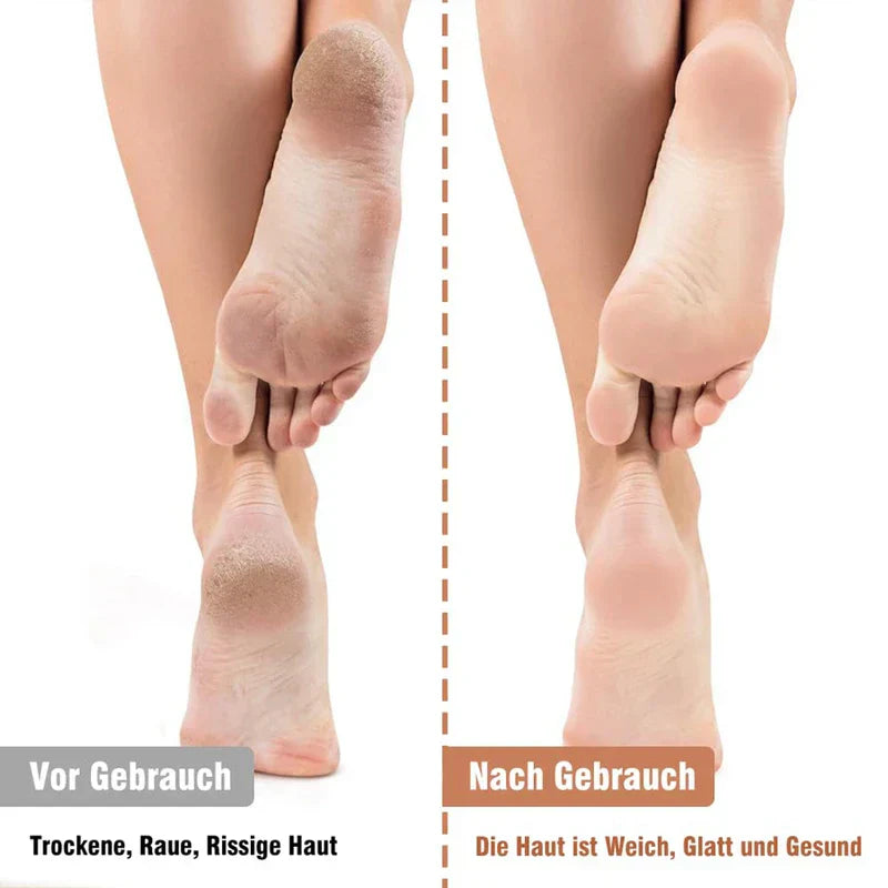 Pedicure Callus Shaver - Split before-and-after comparison of feet: dry rough skin on left, smooth soft skin on right, labeled in German