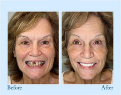 Before and after close-up of a smiling woman showing a complete denture set result