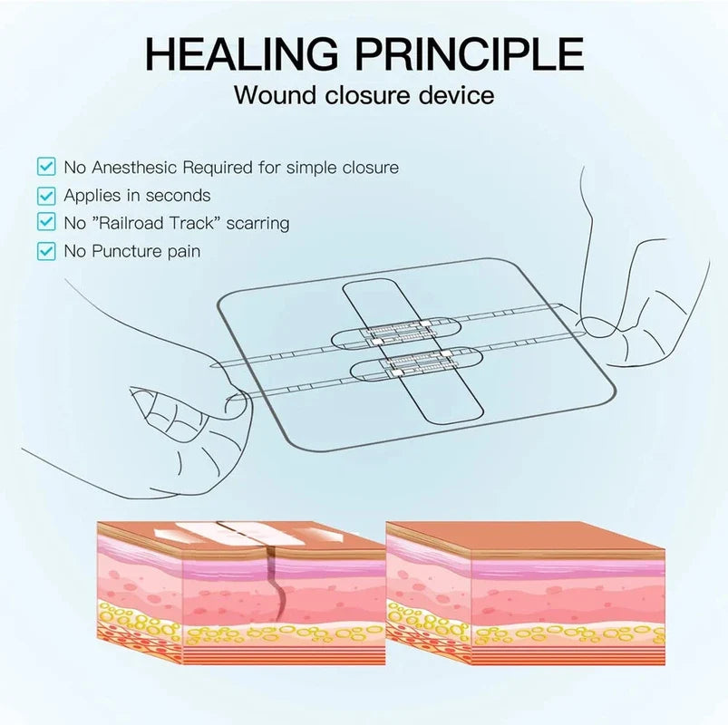Emergency Wound Closures Device - Wound closure device healing principle diagram listing four benefits, with device application and skin cross-section illustrations