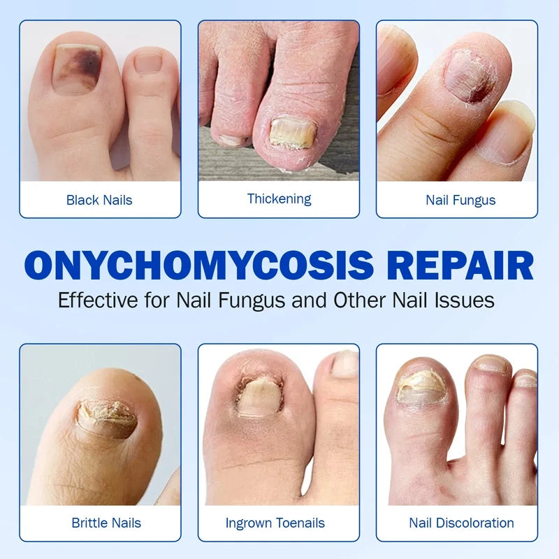 Fungus Patch - Grid of six problematic nail examples: black nail, thickening, fungus, brittle nail, ingrown nail, discolored nail with repair heading