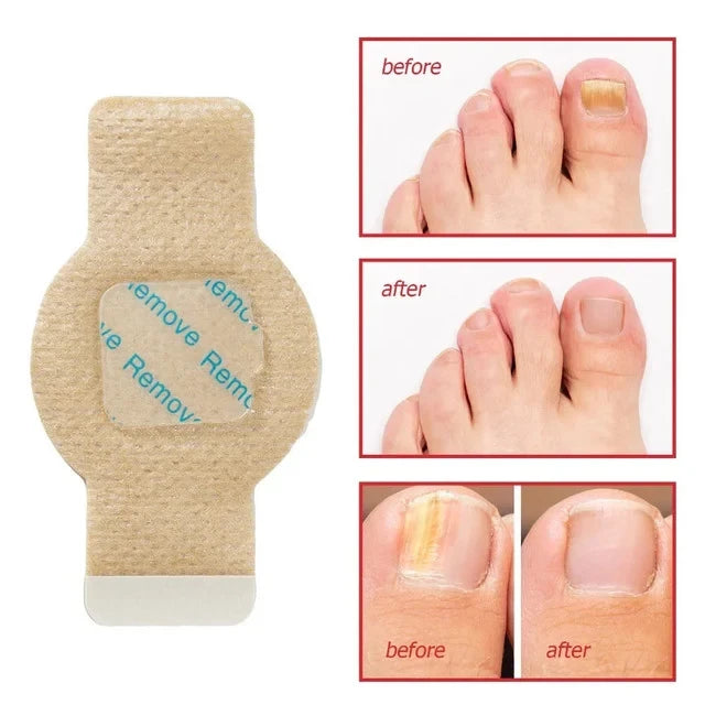 Fungus Patch - Toenail treatment patch beside before-and-after photos showing a discolored toenail appearing clear after use