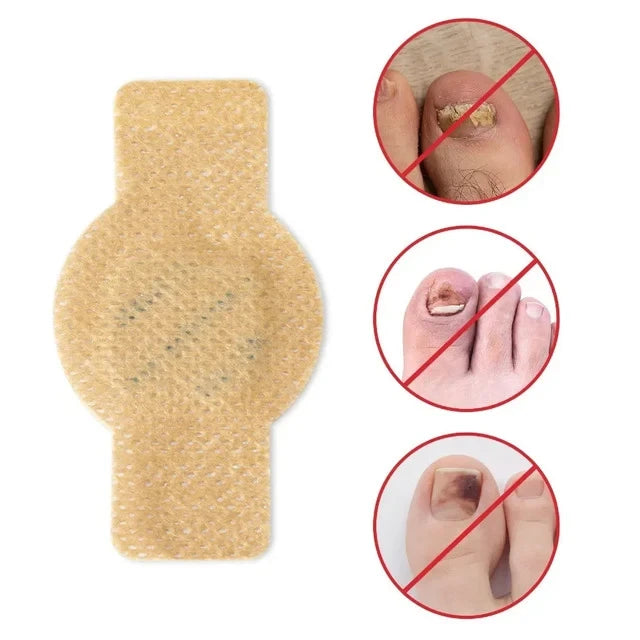 Fungus Patch - Beige toenail patch shown alongside three red crossed-out circles depicting damaged, discolored, and bruised toenails