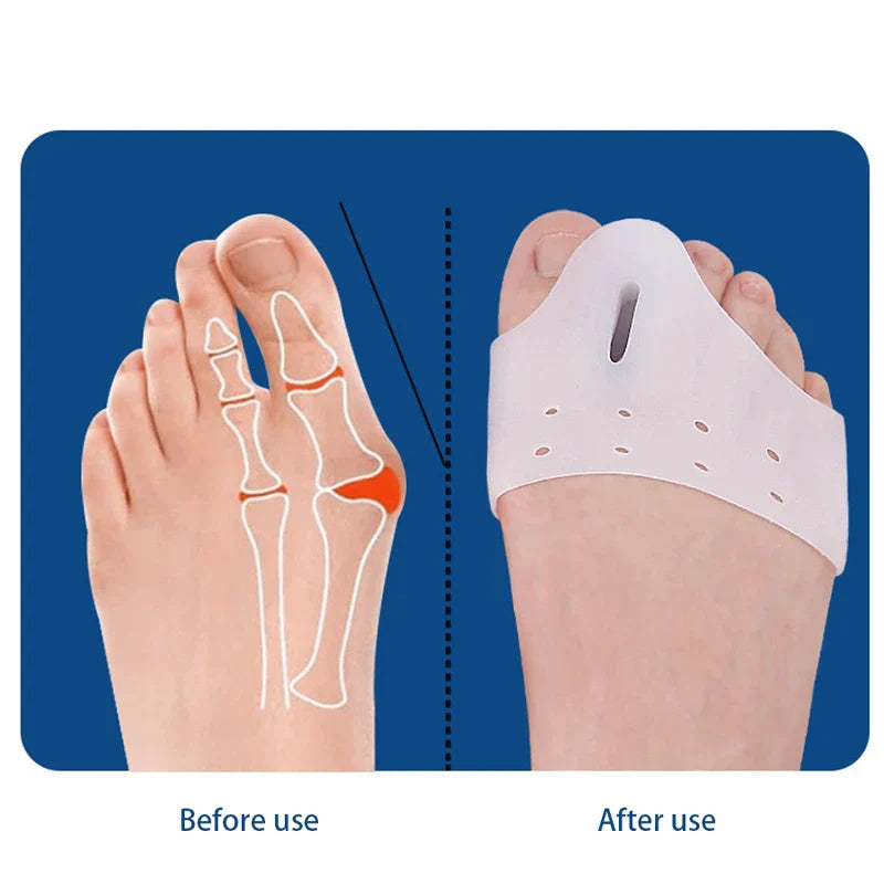 Bunion Corrector Arch Support Sleeve