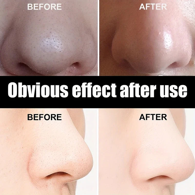 Deep Cleansing Pore Blackhead Remover Nose Strips (10)