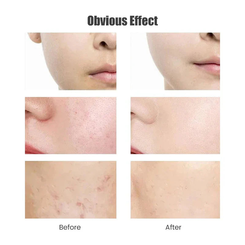 Nano Crystal Needle Free Meso Therapy Injector